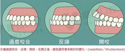 窝沟封闭需要用好的材料吗,窝沟封闭价钱区别(图1)